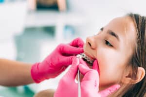 dentist with pink gloves on adjusts the traditional braces in a young girls' mouth