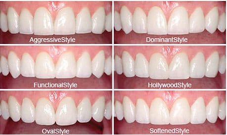diagram of the different style of veneers cropped for mobile part 1