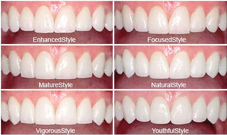 diagram of the different styles of dental veneers cropped for mobile row 2