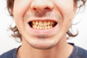 a man shows his yellowed teeth which were caused by smoking cigarettes