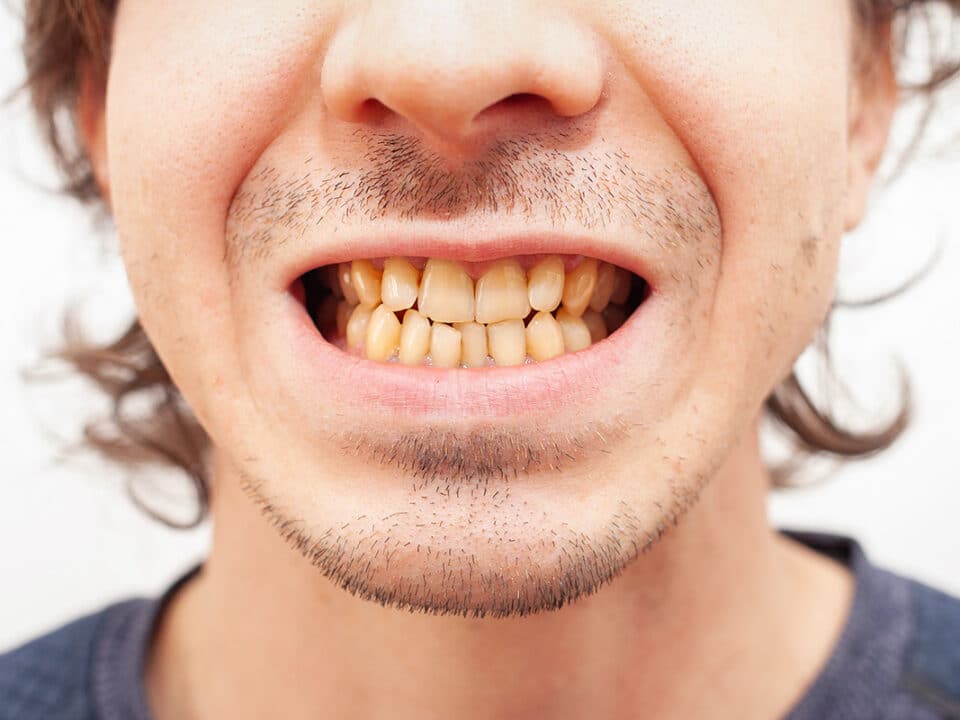 a man shows his yellowed teeth which were caused by smoking cigarettes