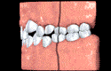 crowded teeth positions