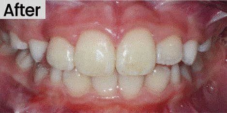 image of a crossbite after treatment