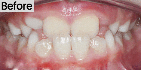 image of a crossbite before treatment