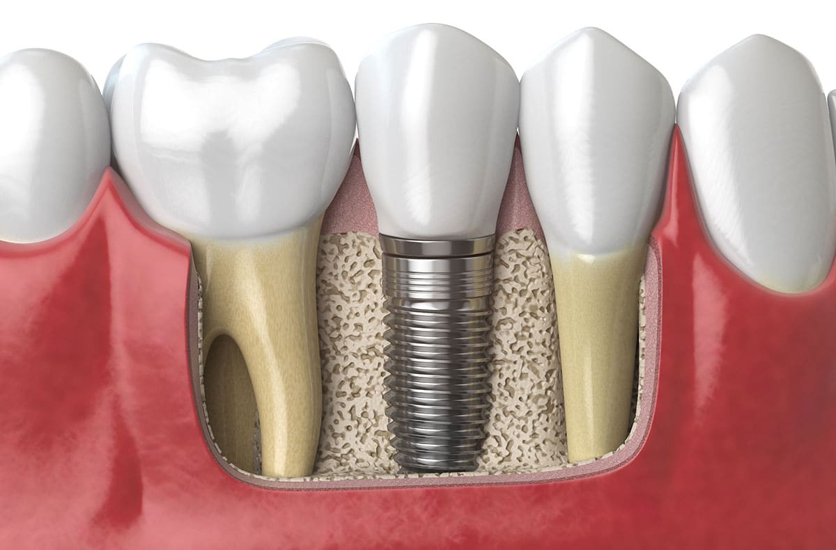 graphic showing how the dental implant procedure works