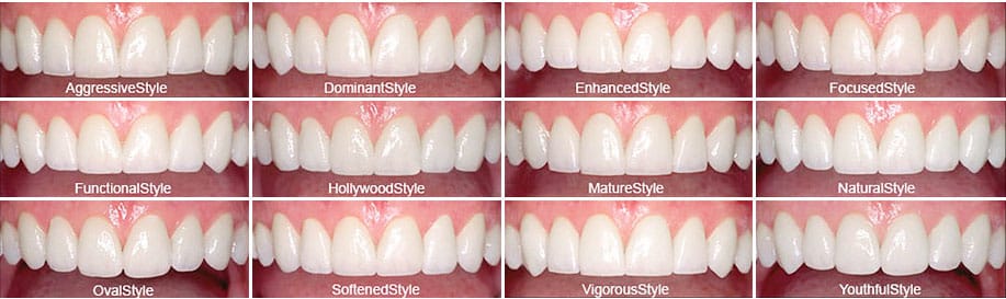 lineup of all the different types of dental veneers styles available at martindale dental