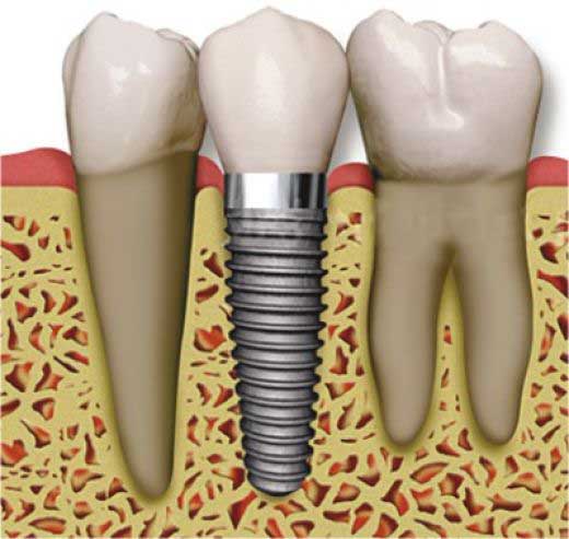 graphic showing a cross section of a dental implant