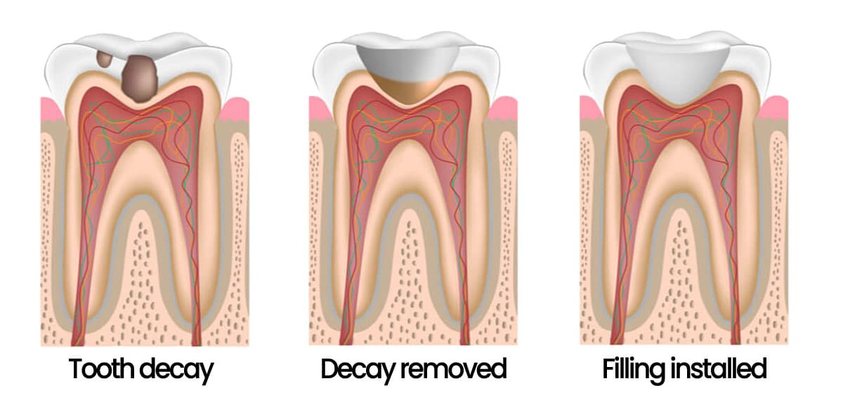 graphic showing the steps involved in using dental fillings to repair a cavity 
