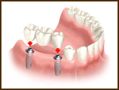 graphic showing a dental implant bridge