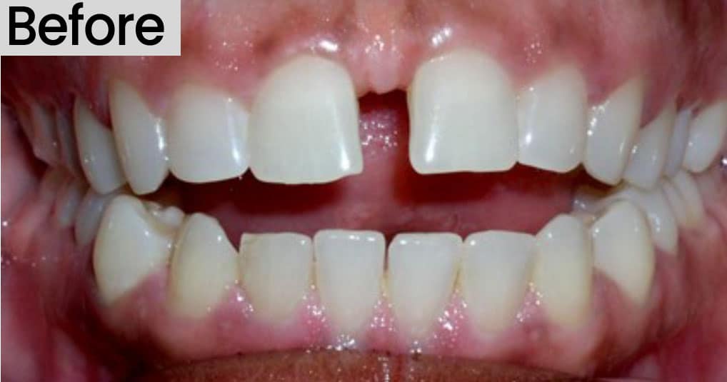 image of an open bite before treatment