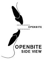 diagram of what an openbite looks like