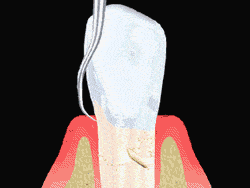 gif animation of dental planing taking place