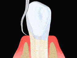 gif animation of dental scaling taking place