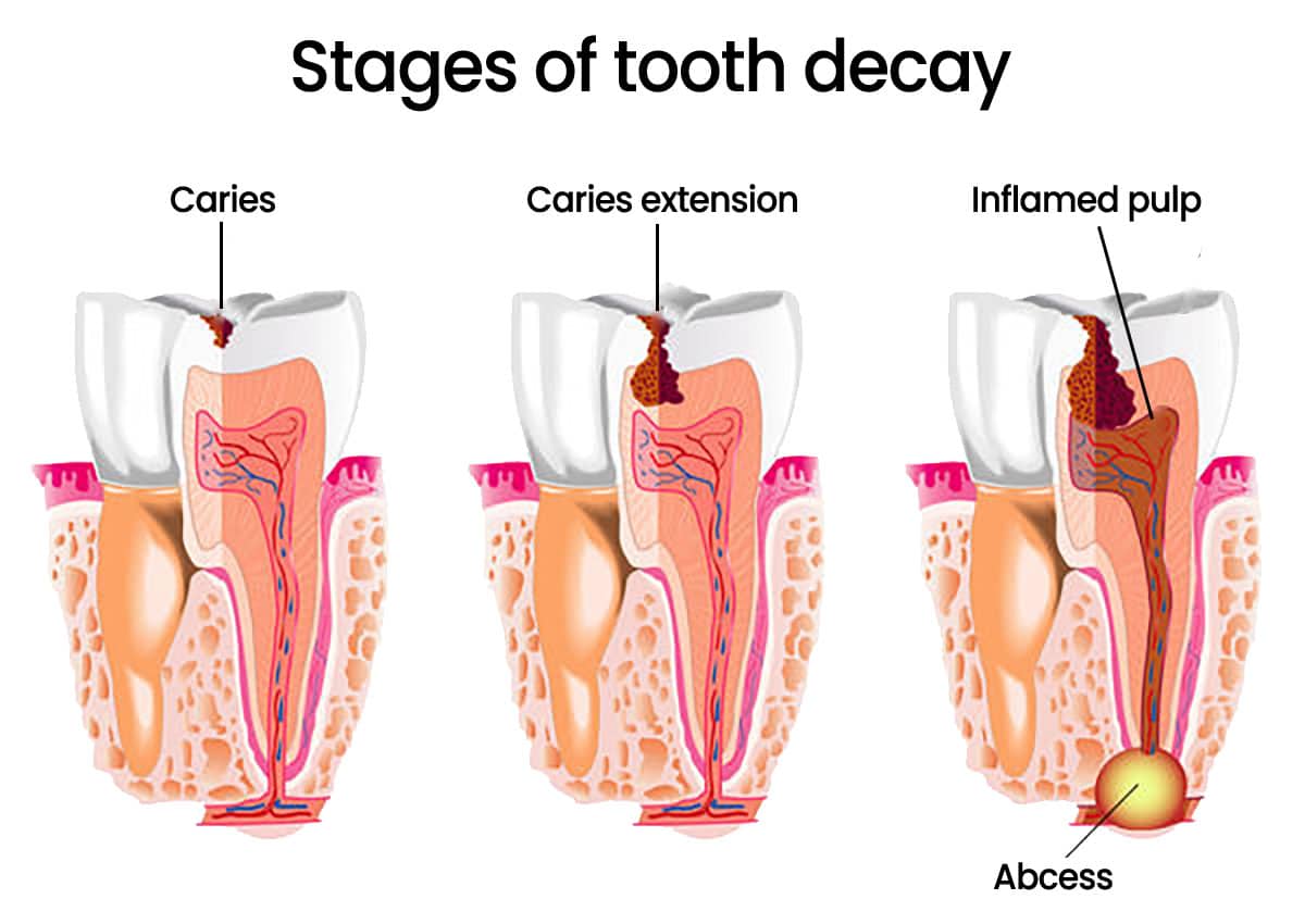 image showing the stages of tooth decay leading to an abscess