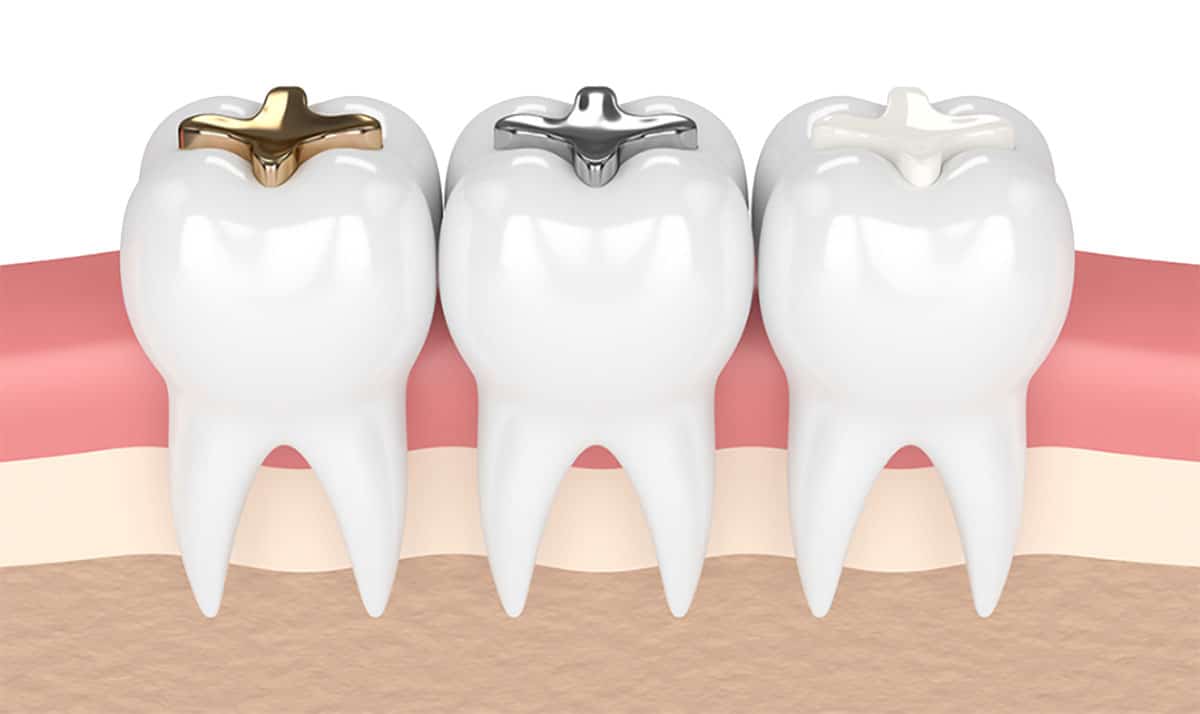 graphic showing the three types of dental fillings