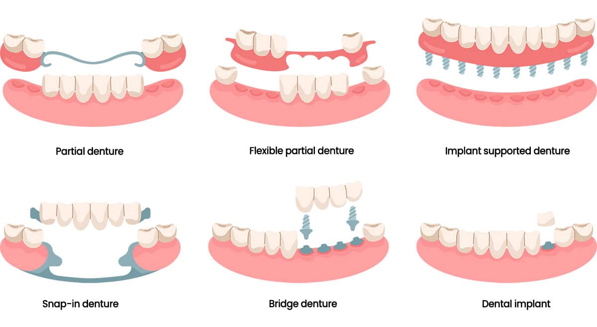 graphic showing the different types of dentures available at Martindale Dental