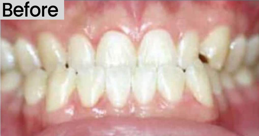 image of an underbite before treatment