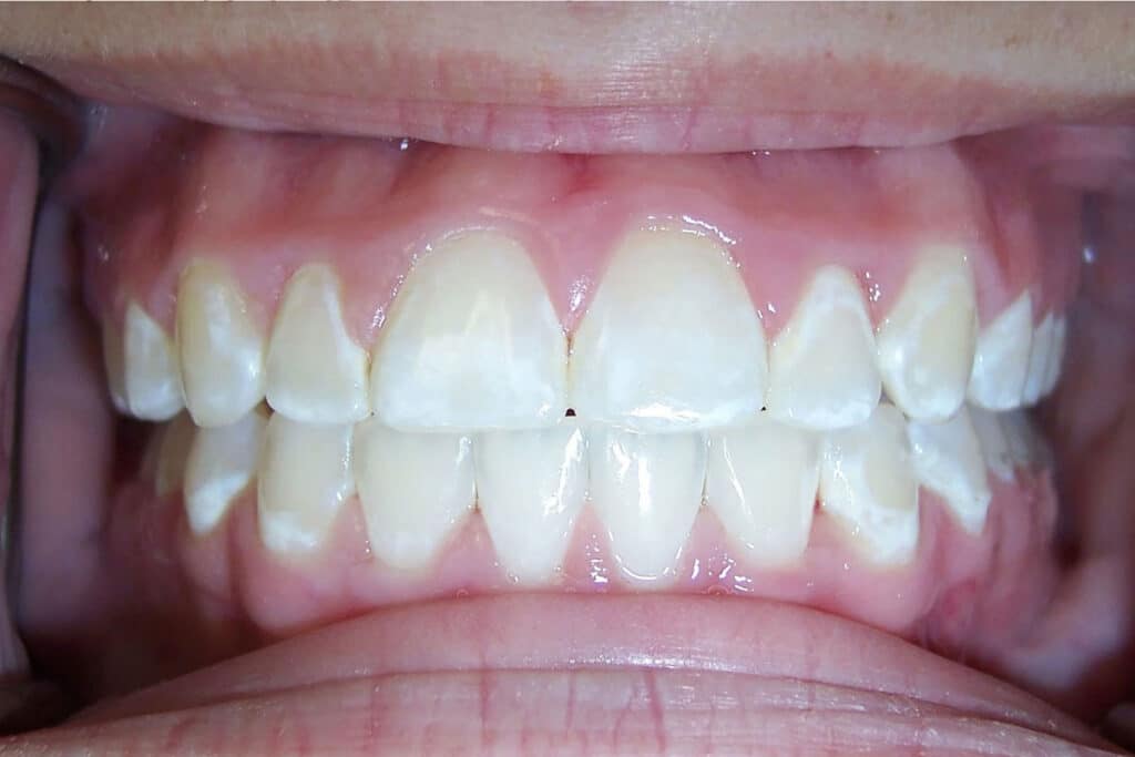 white-patches-in-teeth-after-whitening2.