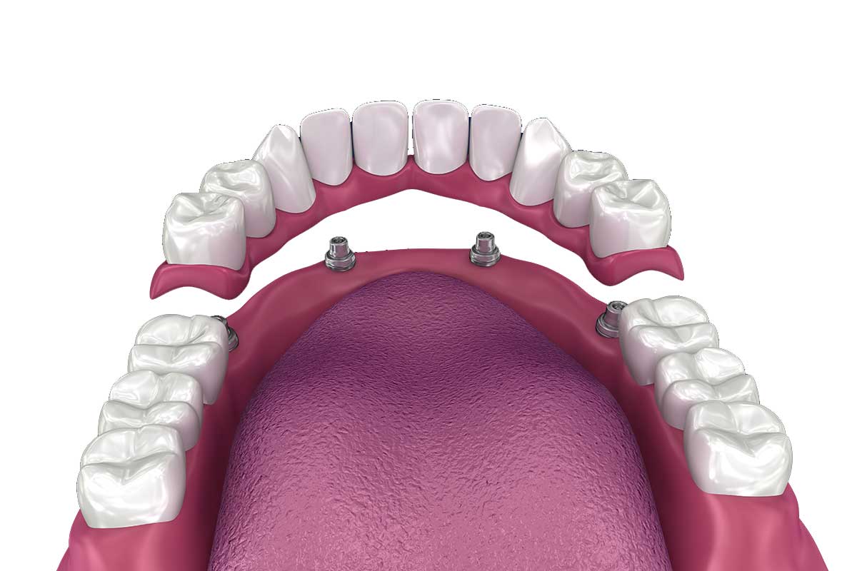 diagram showing a full mouth dental implant