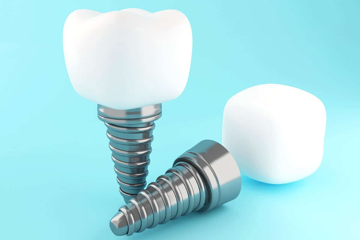 3d model of a dental implant showing the implant posts, abutment and crown attachment