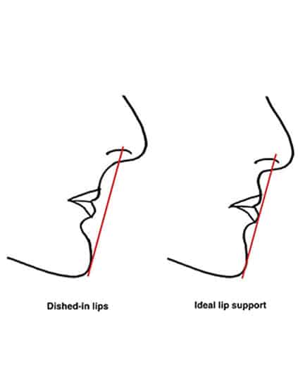 diagram of how veneers offer lip support