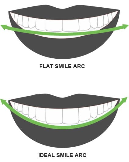 illustration showing a flat vs ideal smile arch for veneers
