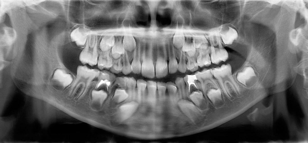 xray showing supernumerary teeth in a patients mouth