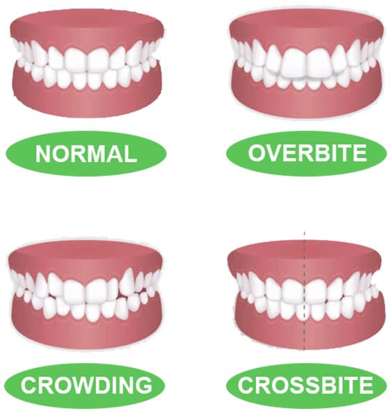 diagram showing four of the different types of bites - cropped for mobile