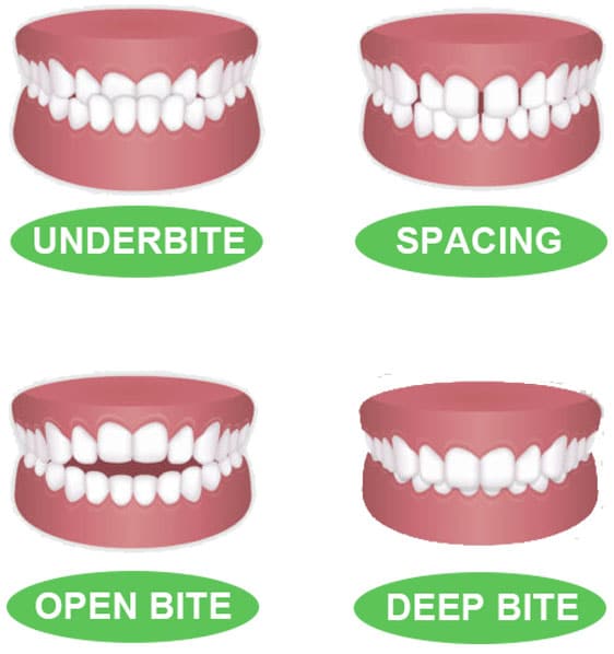 diagram showing the remaining four of the different types of bites - cropped for mobile