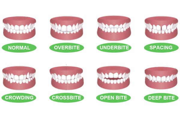 Classification Of Teeth 