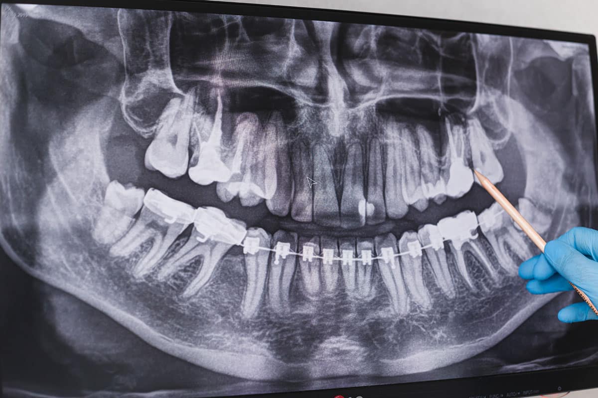 x-ray image of a persons teeth with a dentist pointing out the wisdom teeth that need to be extracted