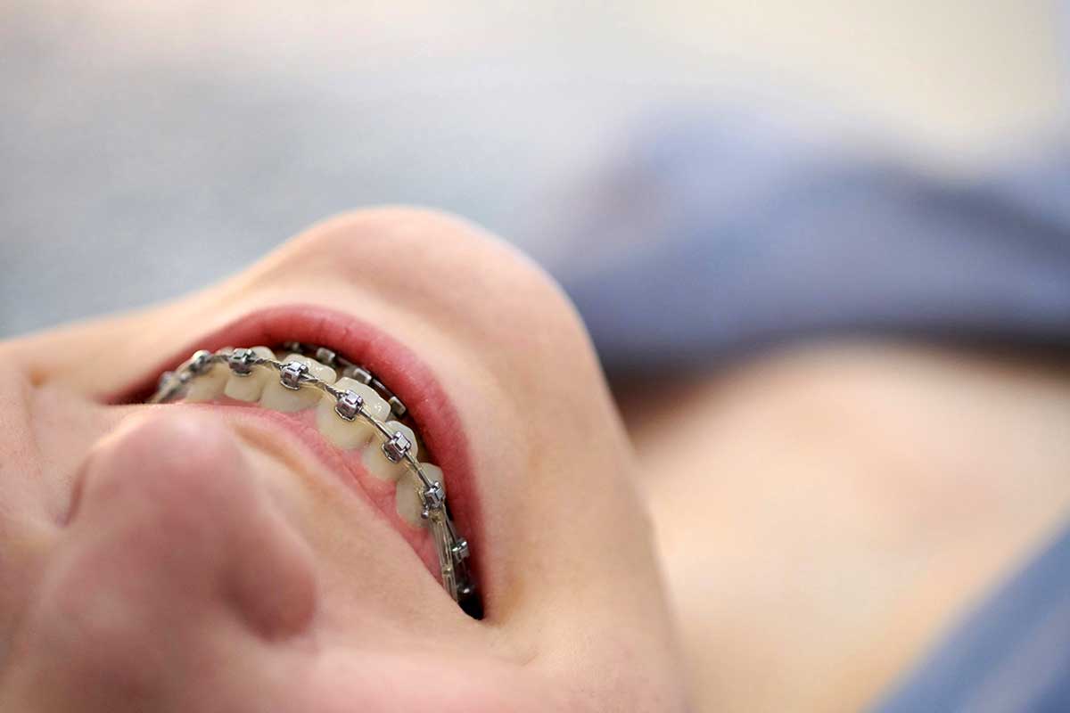 image of a child's mouth that has traditional metal braces attached to the teeth