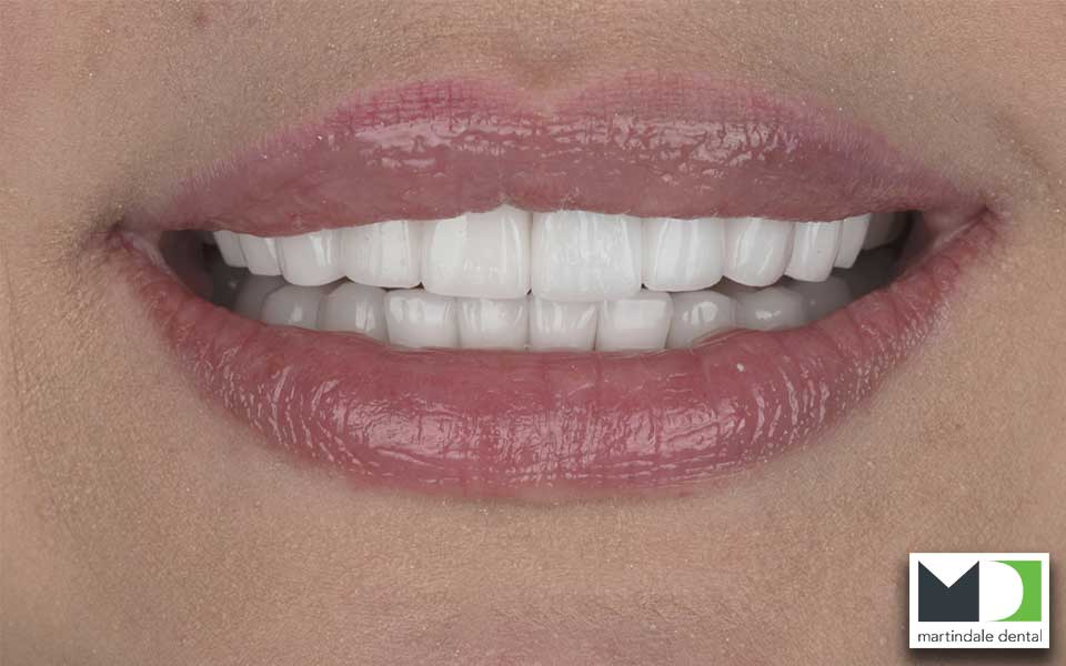 an image showing a womans smile after porcelain crowns from martindale dental in hamilton