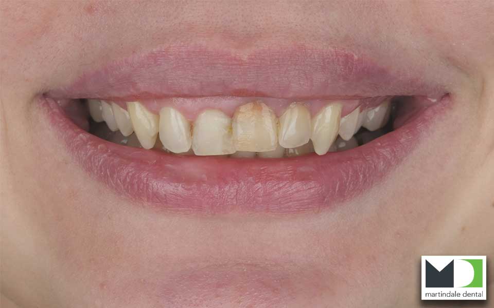 dental-crowns-hamilton-before-3