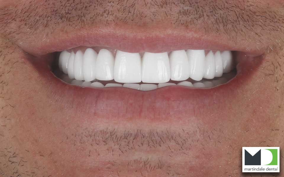 a mans beautiful and white smile after he got dental crowns at our jackson square dental clinic