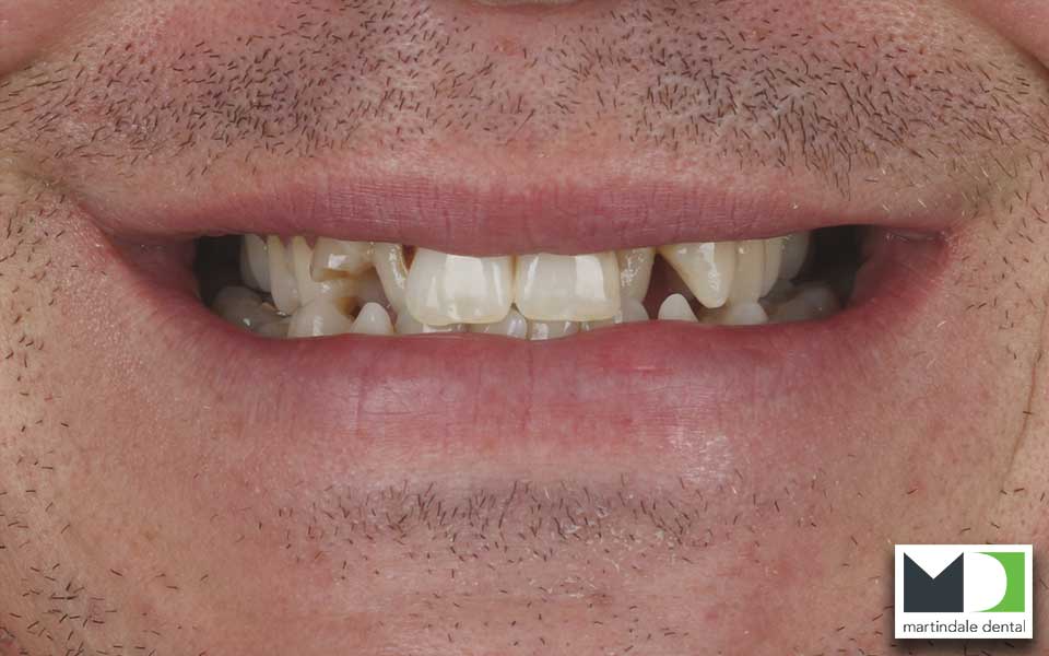 a mans nasty teeth before dental crowns were installed by our jackson square cosmetic dentist