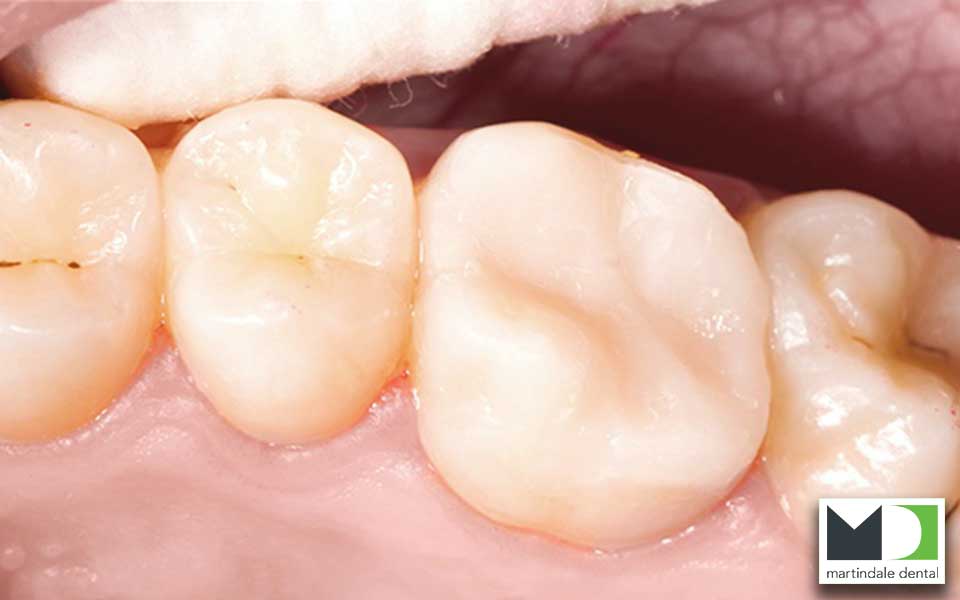 dental-filling-after-2