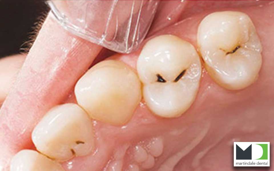 dental-filling-before-1