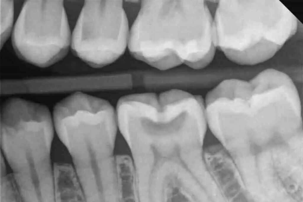 x-ray image showing the result of an occlusal x-ray