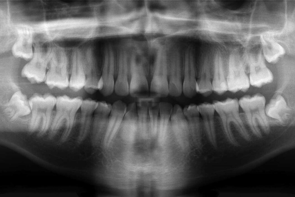 example image of a panoramic dental x-ray