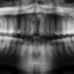 example image of a panoramic dental x-ray