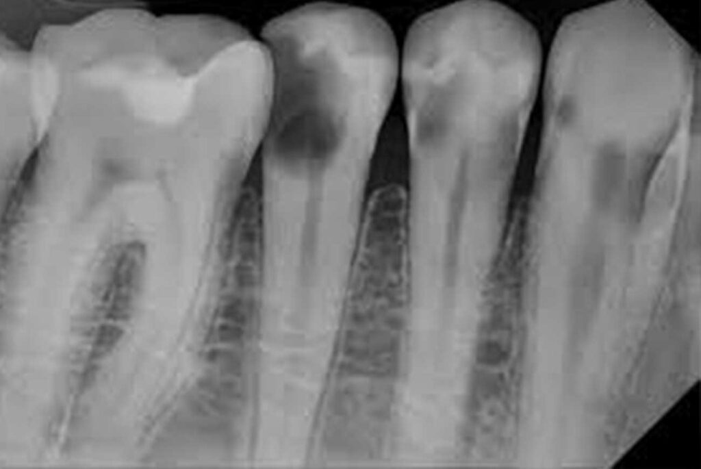 example of a periapical dental x-ray