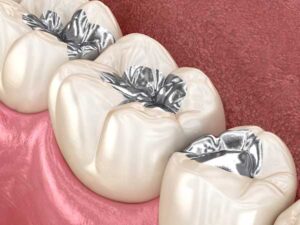 example illustration of teeth showcasing amalgam dental fillings