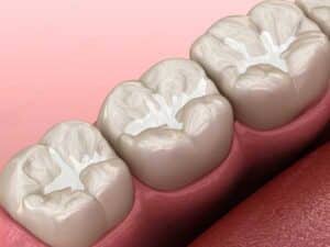 example illustration of teeth showcasing ceramic dental fillings