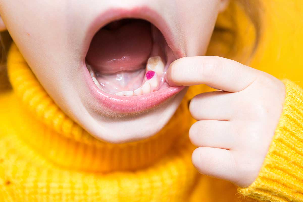 small child shows off a purple coloured dental filling