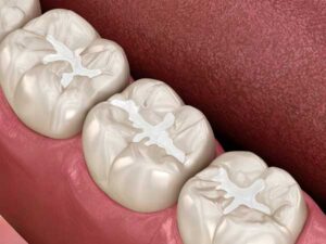 example illustration of teeth showcasing composite resin dental fillings