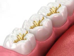 example illustration of teeth showcasing gold dental fillings