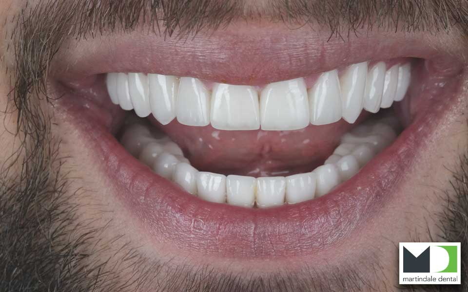 third image showing teeth after dental bonding