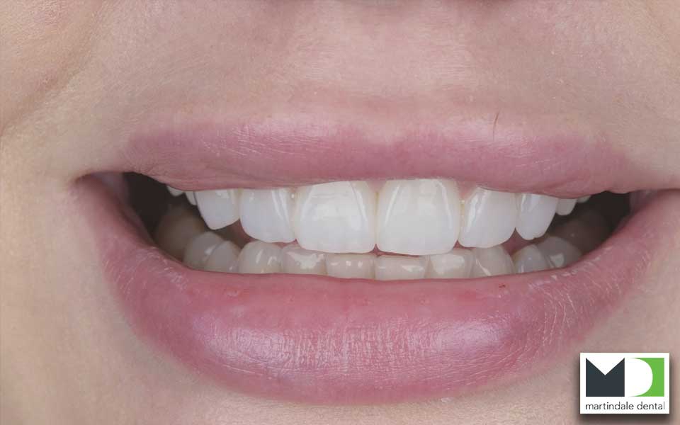 first example image of before dental bonding
