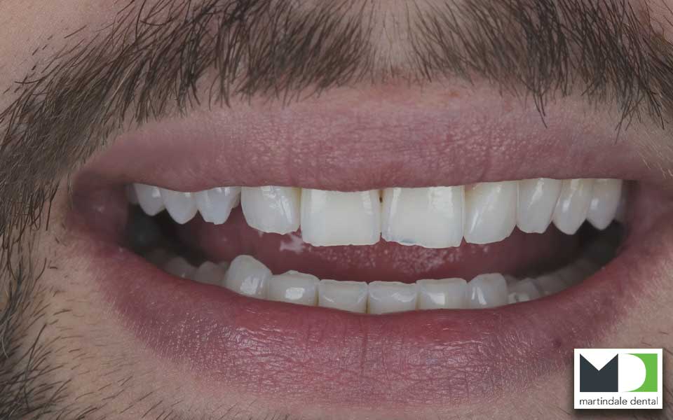 third image showing teeth before dental bonding